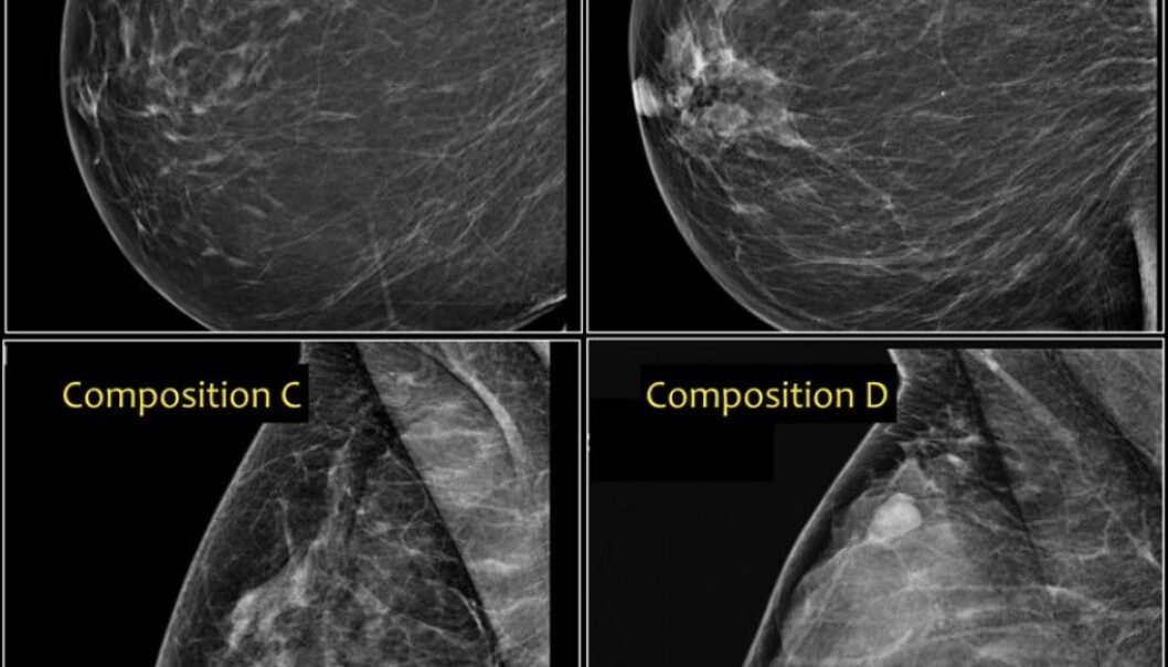 Different breast types affect a woman’s risk of developing cancer. From the upper left, a fatty breast that looks dark in the mammography image (A) has a low risk, while breast types B and C have a medium risk. Type D, which has the highest risk, is characterized by having dense tissue comprised of milk glands and connective tissue. The denser the tissue, the greater the percentage of light areas in the image. (Photo: Radiology Assistant) Different breast types affect a woman’s risk of developing cancer. From the upper left, a fatty breast that looks dark in the mammography image (A) has a low risk, while breast types B and C have a medium risk. Type D, which has the highest risk, is characterized by having dense tissue comprised of milk glands and connective tissue. The denser the tissue, the greater the percentage of light areas in the image. (Photo: Radiology Assistant)