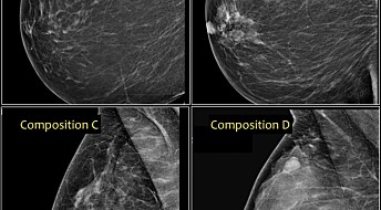 What mammogram images tell us about breast cancer risk