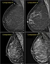 What Mammogram Images Tell Us About Breast Cancer Risk