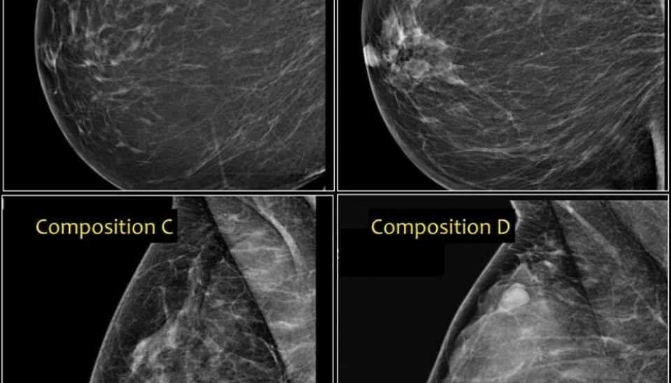 Different breast types affect a woman’s risk of developing cancer. From the upper left, a fatty breast that looks dark in the mammography image (A) has a low risk, while breast types B and C have a medium risk. Type D, which has the highest risk, is characterized by having dense tissue comprised of milk glands and connective tissue. The denser the tissue, the greater the percentage of light areas in the image. (Photo: Radiology Assistant)
