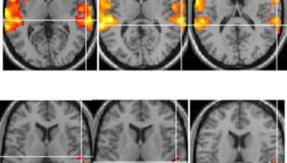 Image captures of the brain show how neurons are activated in healthy control subjects when hearing actual voices (top row) whereas activation fails to occur in patients who experience auditory hallucinations. (Photo: Kenneth Hugdahl)