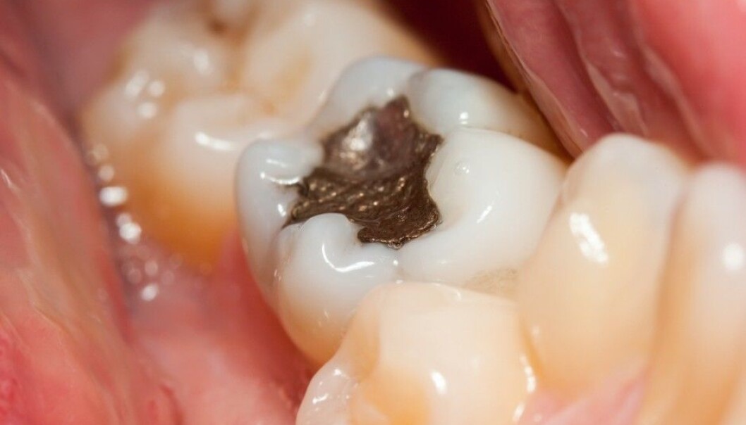 Dentists have used amalgam since at least the 1800s. The discussion as to whether or not the mercury in the amalgam is bad for patients is almost as old. (Illustration photo: Szasz-Fabian Jozsef, Shutterstock/NTB scanpix) Dentists have used amalgam since at least the 1800s. The discussion as to whether or not the mercury in the amalgam is bad for patients is almost as old. (Illustration photo: Szasz-Fabian Jozsef, Shutterstock/NTB scanpix)