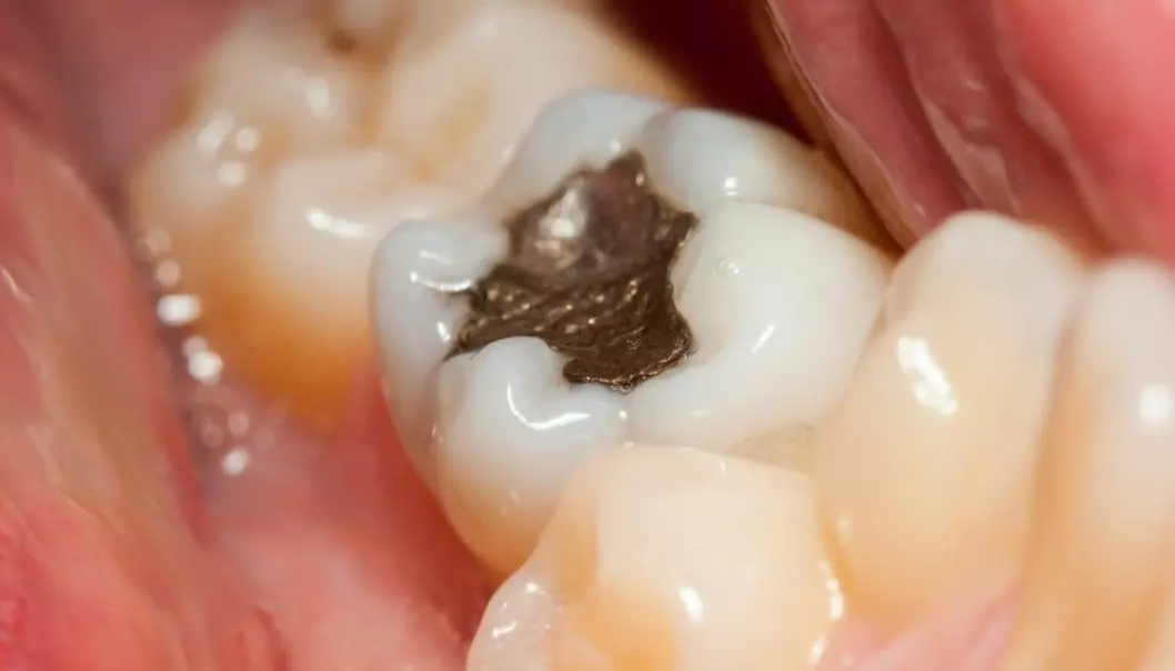 Dentists have used amalgam since at least the 1800s. The discussion as to whether or not the mercury in the amalgam is bad for patients is almost as old. (Illustration photo: Szasz-Fabian Jozsef, Shutterstock/NTB scanpix)