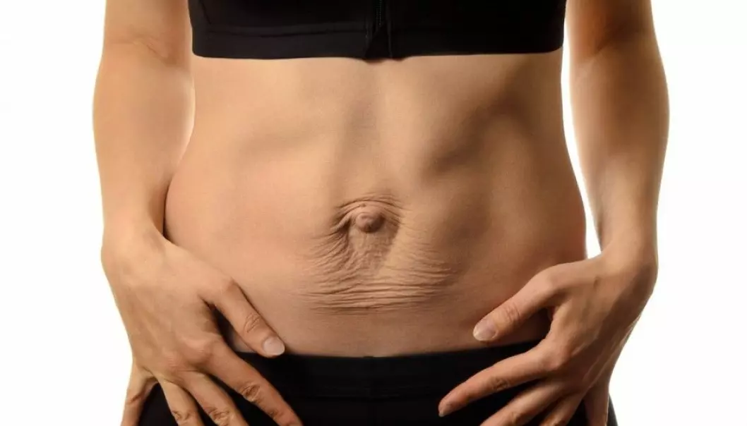 Many women experience diastasis recti abdominis, or separated abdominal muscles, after pregnancy. Most find that their muscles pull together again, but some women continue to have the problem well after the baby is born, as shown in this photograph. Experts have long recommended a group of exercises as treatment, but researchers at the Norwegian School of Sport Sciences (NIH) have done a study that suggests the exercises don’t work. And Kari Bø, a NIH professor who was a co-author of the study, says it’s not clear that diastasis recti abdominis is actually a problem. (Photo: Tetiana Mandziuk / Shutterstock / NTB scanpix)