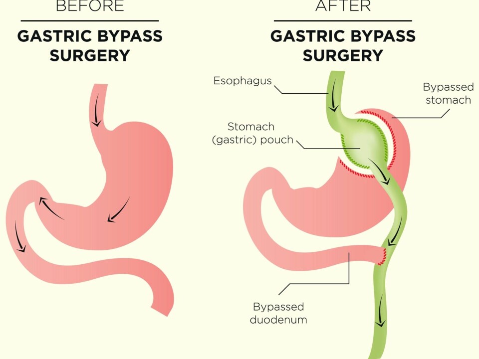 A gastric bypass, also called bariatric surgery, drastically reduces the size of the stomach. The surgeon creates a small pocket at the top of the stomach and connects it to the small intestine. The rest of the stomach is bypassed. The stomach consequently has room for far less food after the procedure. The food that previously passed through the stomach and duodenum now bypasses this part of the digestive tract, according to the NHI.no website. (Illustration: bearsky23 / Shutterstock / NTB scanpix)
