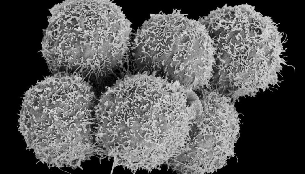 Women with bladder cancer are often misdiagnosed with a bladder infection before a cancer diagnosis is made. Bladder infections can also cause pain and blood in the urine. Here you can see bladder cancer cells. (Photo: Science Photo Library, NTB scanpix) Women with bladder cancer are often misdiagnosed with a bladder infection before a cancer diagnosis is made. Bladder infections can also cause pain and blood in the urine. Here you can see bladder cancer cells. (Photo: Science Photo Library, NTB scanpix)