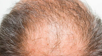 Why do men grow bald?