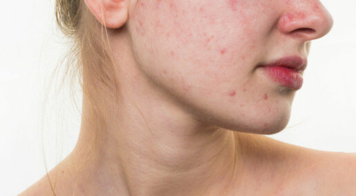 Acne bacteria survive by feasting on their hosts