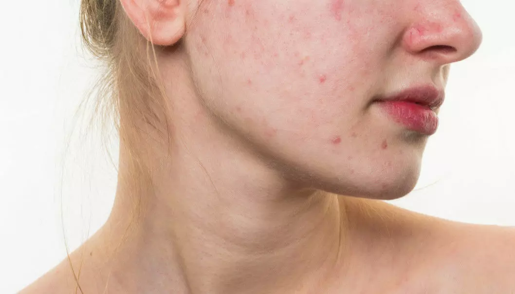 Scientists have discovered how acne bacteria survive. They feed on their host organisms – us. (Photo: Shutterstock)