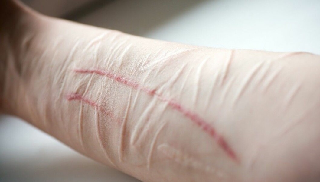 Self-harming behaviour are sometimes but not always be related to suicide attempts, and can range from superficial cutting to life-threatening injuries. It is most common among young people and young adults. (Photo: Shutterstock)