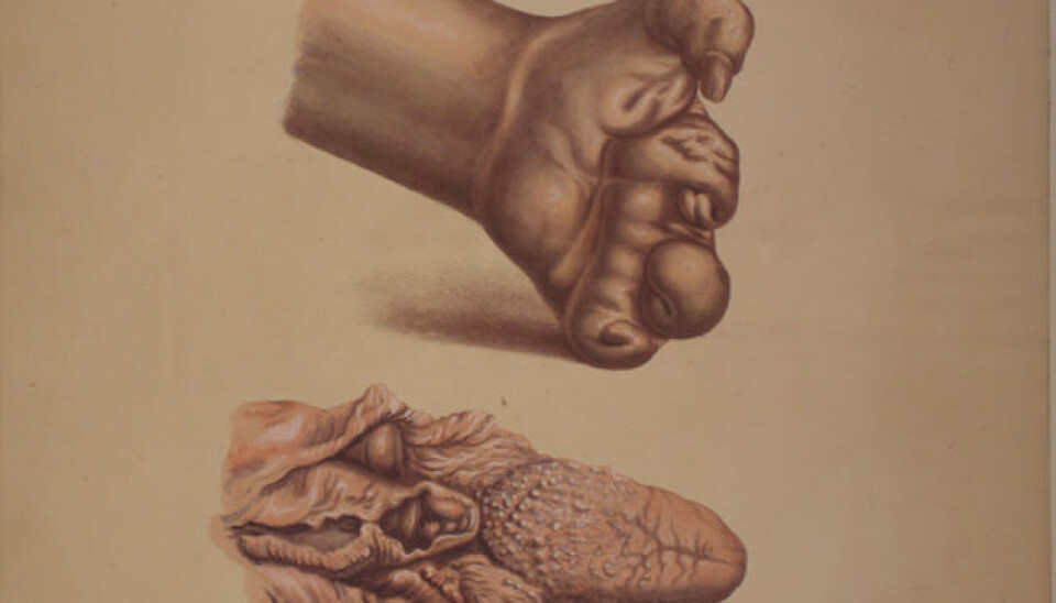 Illustration from J.L. Losting’s Leprosy Atlas. A deformed hand caused by smooth leprosy, whereas the tongue and portion of throat below has been afflicted with elephantiasis or “knobby' leprosy. (Reprinted courtesy of the Leprosy Museum St. Jørgens Hospital/ the Bergen City Museum)