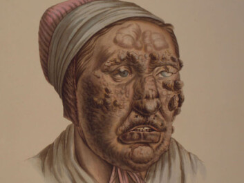 Illustration from J.L. Losting’s Leprosy Atlas. A 28 year old woman. (Reprinted courtesy of the Leprosy Museum St. Jørgens Hospital/ the Bergen City Museum) Illustration from J.L. Losting’s Leprosy Atlas. A 28 year old woman. (Reprinted courtesy of the Leprosy Museum St. Jørgens Hospital/ the Bergen City Museum)