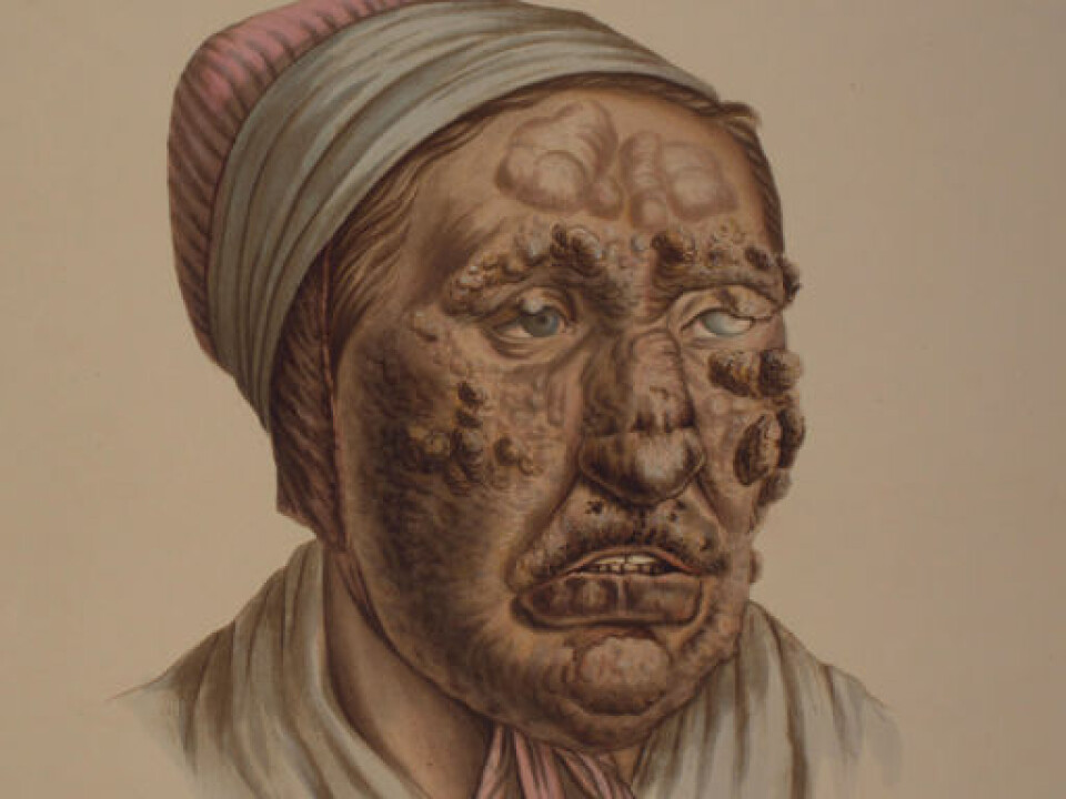 Illustration from J.L. Losting’s Leprosy Atlas. A 28 year old woman. (Reprinted courtesy of the Leprosy Museum St. Jørgens Hospital/ the Bergen City Museum)