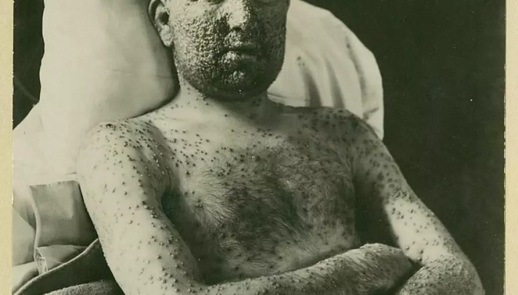 A smallpox patient at Ullevål Hospital, ca. 1900. (Photo: Oslo University Hospital Ullevål)