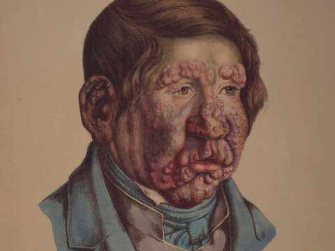 The horrific disease that won't die