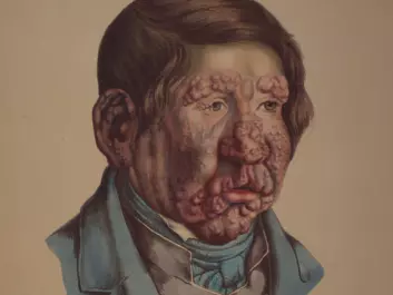 Illustration from J.L. Losting’s Leprosy Atlas. A 13 year old boy. He became ill when he was six years old. (Reprinted courtesy of the Leprosy Museum St. Jørgens Hospital/ the Bergen City Museum)