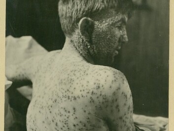 The disease ravaged the young. This boy was a patient at the Ullevål Hospital in the beginning of the 20th Century. (Photo: Oslo University Hospital Ullevål) The disease ravaged the young. This boy was a patient at the Ullevål Hospital in the beginning of the 20th Century. (Photo: Oslo University Hospital Ullevål)