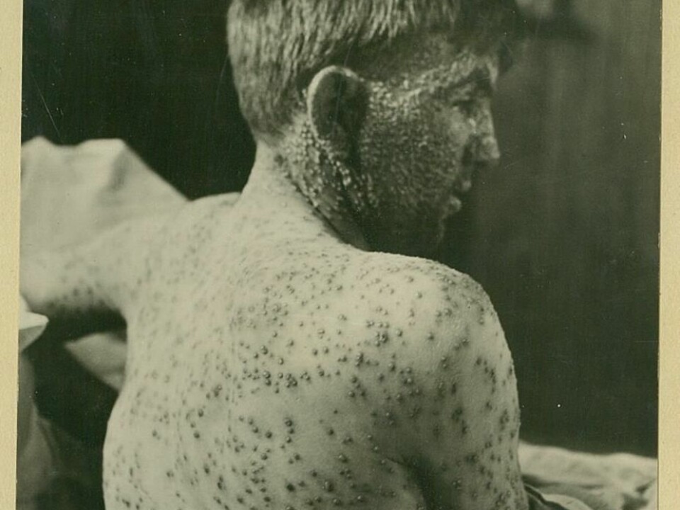 The disease ravaged the young. This boy was a patient at the Ullevål Hospital in the beginning of the 20th Century. (Photo: Oslo University Hospital Ullevål)