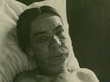 Facial infections, blisters and pustules could render the patient unrecognizable. (Photo: Oslo University Hospital Ullevål)
