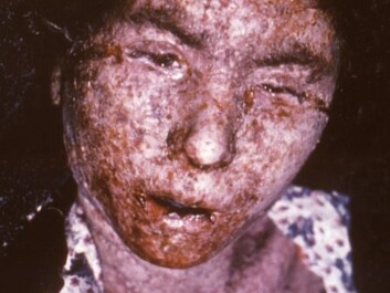 Smallpox left terrible and permanent scars. This is Italian patient was photographed in 1965, just about a decade before the disease was wiped out. (Photo: CDC/ Carl Flint/Armed Forces Institute of Pathology/Wikimedia Creative Commons) Smallpox left terrible and permanent scars. This is Italian patient was photographed in 1965, just about a decade before the disease was wiped out. (Photo: CDC/ Carl Flint/Armed Forces Institute of Pathology/Wikimedia Creative Commons)