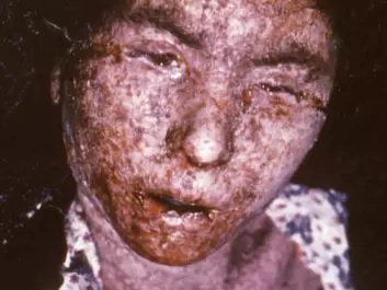 Smallpox left terrible and permanent scars. This is Italian patient was photographed in 1965, just about a decade before the disease was wiped out.  (Photo: CDC/ Carl Flint/Armed Forces Institute of Pathology/Wikimedia Creative Commons)