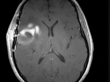 This is what a hard, or solid stress, cancerous tumour looks like. This type of tumour is more resistant to standard treatment than soft cancerous tumours. (Photo: Kyrre Eeg Emblem) This is what a hard, or solid stress, cancerous tumour looks like. This type of tumour is more resistant to standard treatment than soft cancerous tumours. (Photo: Kyrre Eeg Emblem)