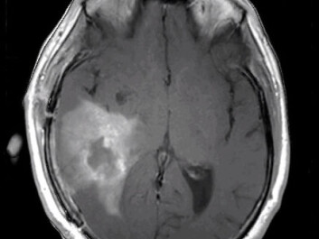 Here you see a soft, or infiltrating, cancerous tumour. (Photo: Kyrre Eeg Emblem) Here you see a soft, or infiltrating, cancerous tumour. (Photo: Kyrre Eeg Emblem)