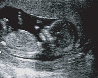 In addition to having a lower risk of miscarriages and premature births, women who received metformin also gained less during pregnancy, researchers found. (Photo: Colourbox) In addition to having a lower risk of miscarriages and premature births, women who received metformin also gained less during pregnancy, researchers found. (Photo: Colourbox)
