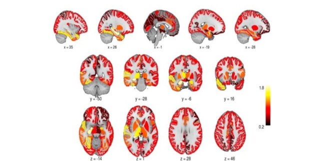 The grey matter of the brain increased in volume after electroconvulsive therapy. The grey matter of the brain increased in volume after electroconvulsive therapy.