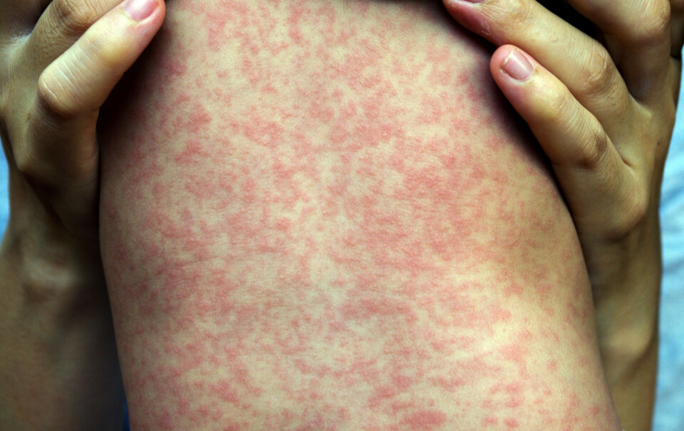 Measles gives you a rash all over your body, but also fever and possible additional illnesses.