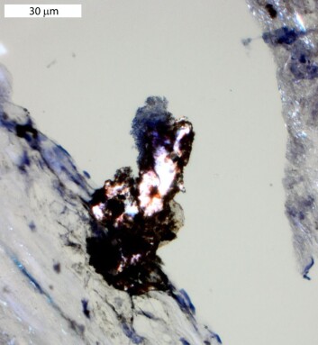 The image shows a cholesterol crystal surrounded by monocytes that are expressing “tissue factor” on their surface, which helps contribute to activate coagulation and blood clotting. Scale bar is 30 µm (1000 µm = 1mm). (Photo: CEMIR) The image shows a cholesterol crystal surrounded by monocytes that are expressing “tissue factor” on their surface, which helps contribute to activate coagulation and blood clotting. Scale bar is 30 µm (1000 µm = 1mm). (Photo: CEMIR)