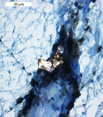 The image shows a cholesterol crystal (bright white) surrounded by monocytes (brown staining) in material from a stroke patient. The scale bar is 30 µm (1000 µm = 1mm). (Photo: CEMIR) The image shows a cholesterol crystal (bright white) surrounded by monocytes (brown staining) in material from a stroke patient. The scale bar is 30 µm (1000 µm = 1mm). (Photo: CEMIR)