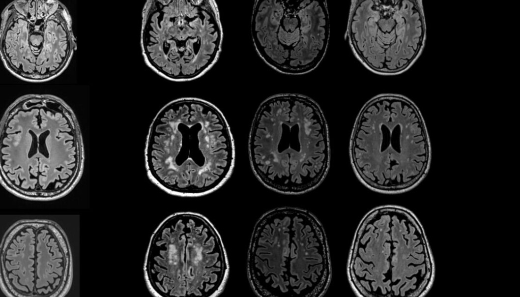 Here are MRIs of different brains with varying degrees of white spots. Here are MRIs of different brains with varying degrees of white spots.