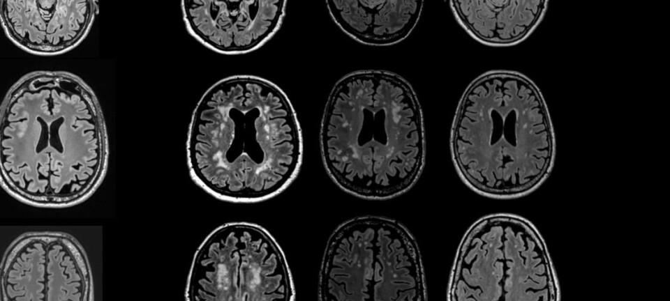 Smoking may cause white scars on the brain