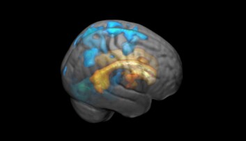 The effects of the white spots increase in volume as they spread across the surface of the brain. Here marked in blue The effects of the white spots increase in volume as they spread across the surface of the brain. Here marked in blue