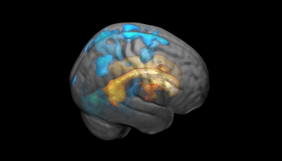 The effects of the white spots increase in volume as they spread across the surface of the brain. Here marked in blue