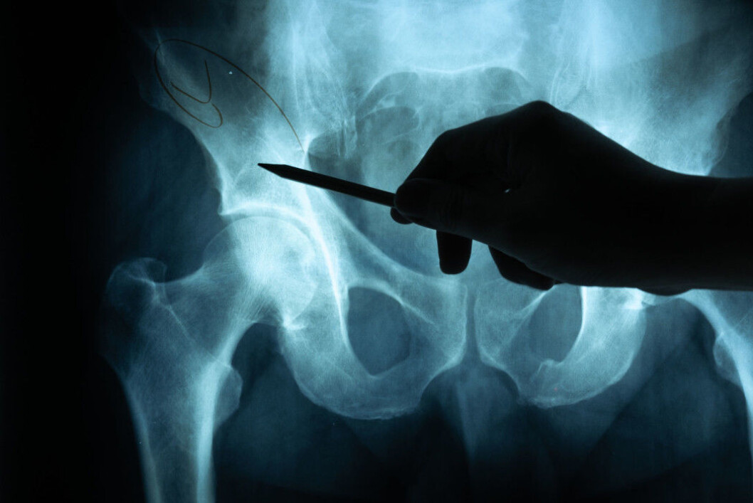 About 21 per cent of women and as many as 33 per cent of men die within the first year after sustaining a hip fracture. About 21 per cent of women and as many as 33 per cent of men die within the first year after sustaining a hip fracture.