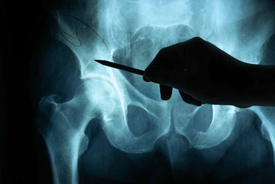 About 21 per cent of women and as many as 33 per cent of men die within the first year after sustaining a hip fracture.