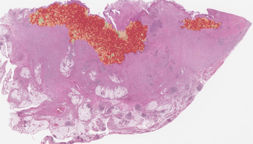 From thousands of images, artificial intelligence draws conclusions about the prognosis of each individual tumor.