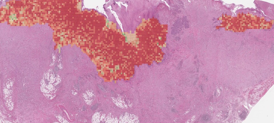 Bowel cancer: Artificial intelligence can reduce overtreatment and wrong treatment