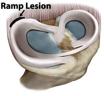This is what a “ramp lesion” looks like: the meniscus is torn away from its attachment in the joint capsule. This is what a “ramp lesion” looks like: the meniscus is torn away from its attachment in the joint capsule.