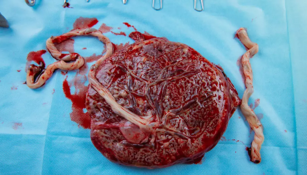 The placenta is examined after birth to see if it is intact. How the placenta grows can give a clue as to the conditions the foetus experienced in the uterus.