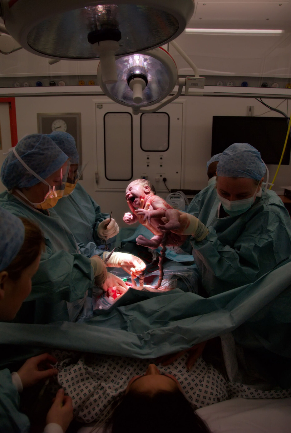 The fetus should not have to pass through a narrow opening in the bony skeleton on the way out. The solution – the Caesarean section.