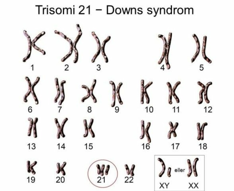 Three copies of a chromosome create a trisomy. It is possible to count the number of chromosomes with a microscope, as this illustration shows. But for cell-free DNA, measured with NIPT, more advanced DNA technology is needed. (Illustration: Kateryna Kon / Shutterstock / NTB scanpix)