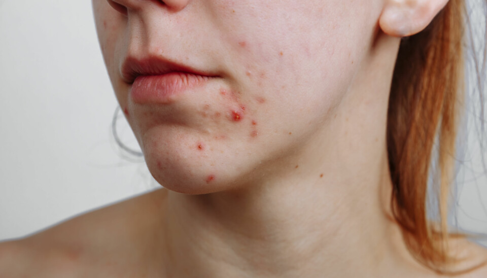 Acne usually crops up at puberty in the ages of 10-12, earlier among girls than boys.