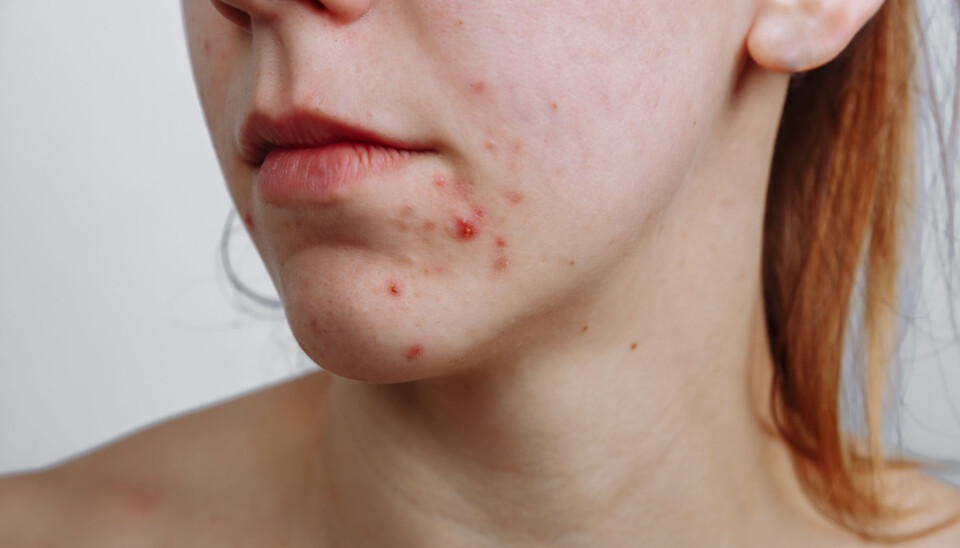 Acne usually crops up at puberty in the ages of 10-12, earlier among girls than boys.