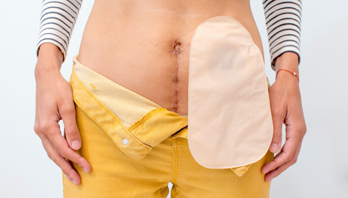 In people with Crohn's disease, immune reactions cause inflammation in the intestines. For the hardest hit patients, it is sometimes necessary to remove parts of the intestine. Some people require a stoma. In people with Crohn's disease, immune reactions cause inflammation in the intestines. For the hardest hit patients, it is sometimes necessary to remove parts of the intestine. Some people require a stoma.