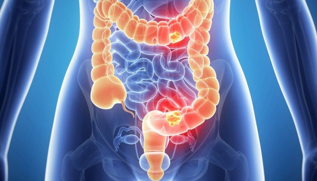 Norway is one of the countries with the highest prevalence of colon cancer. Every day ten Norwegians are diagnosed with this type of cancer. Norway is one of the countries with the highest prevalence of colon cancer. Every day ten Norwegians are diagnosed with this type of cancer.
