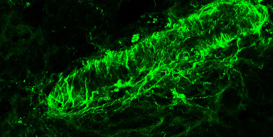 Through advanced microscopes, the researchers were able to detect the cholesterol crystals. Here is a vein from the uterine wall. The green is both cells and a fiber-forming protein.