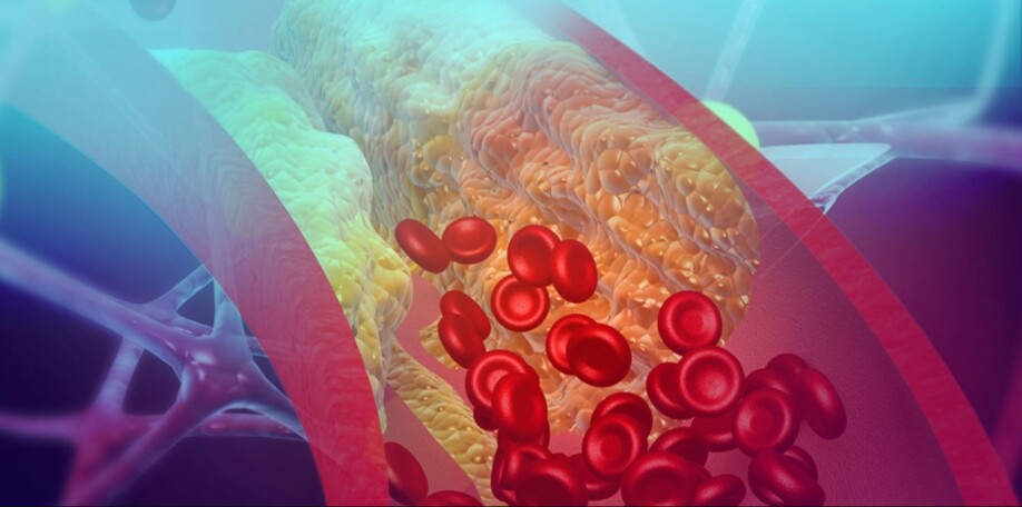 The heart pumps about five litres of blood through the body every minute. The blood vessels that carry blood from the heart become clogged with something called plaque. Cholesterol crystals are found in plaque.
